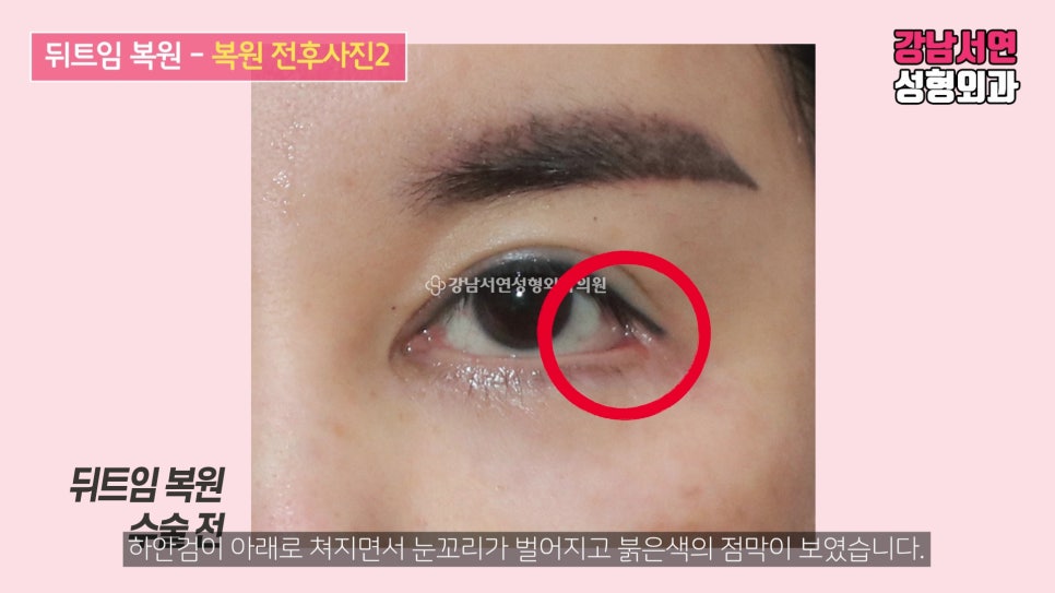 쌍꺼풀 재수술 사례 눈 사진