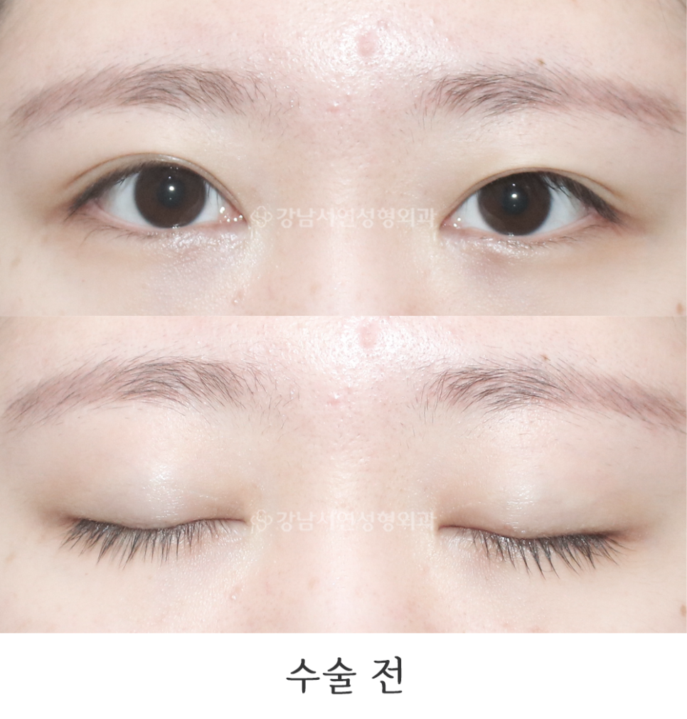 쌍꺼풀 재수술 전 사진