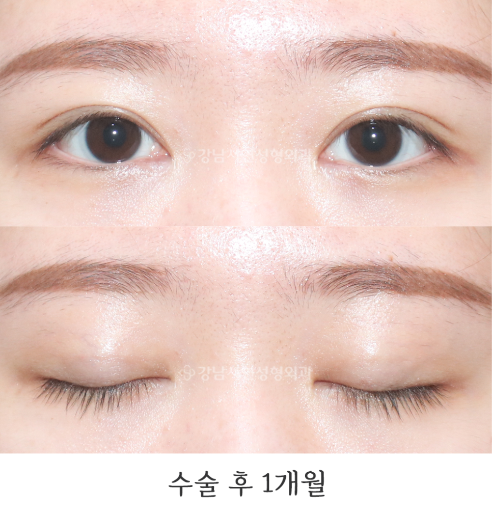 쌍꺼풀 재수술 후 사진