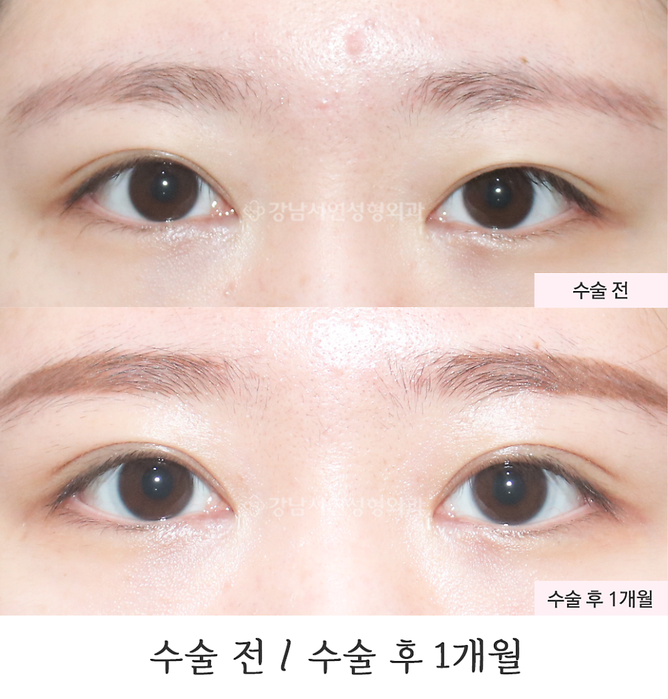 쌍꺼풀 재수술 전후 비교 사진