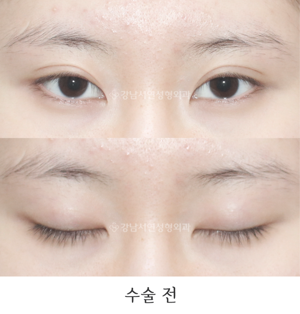 두줄따기 수술 전 사진
