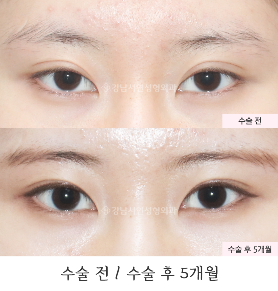 두줄따기 수술 전후 비교 사진