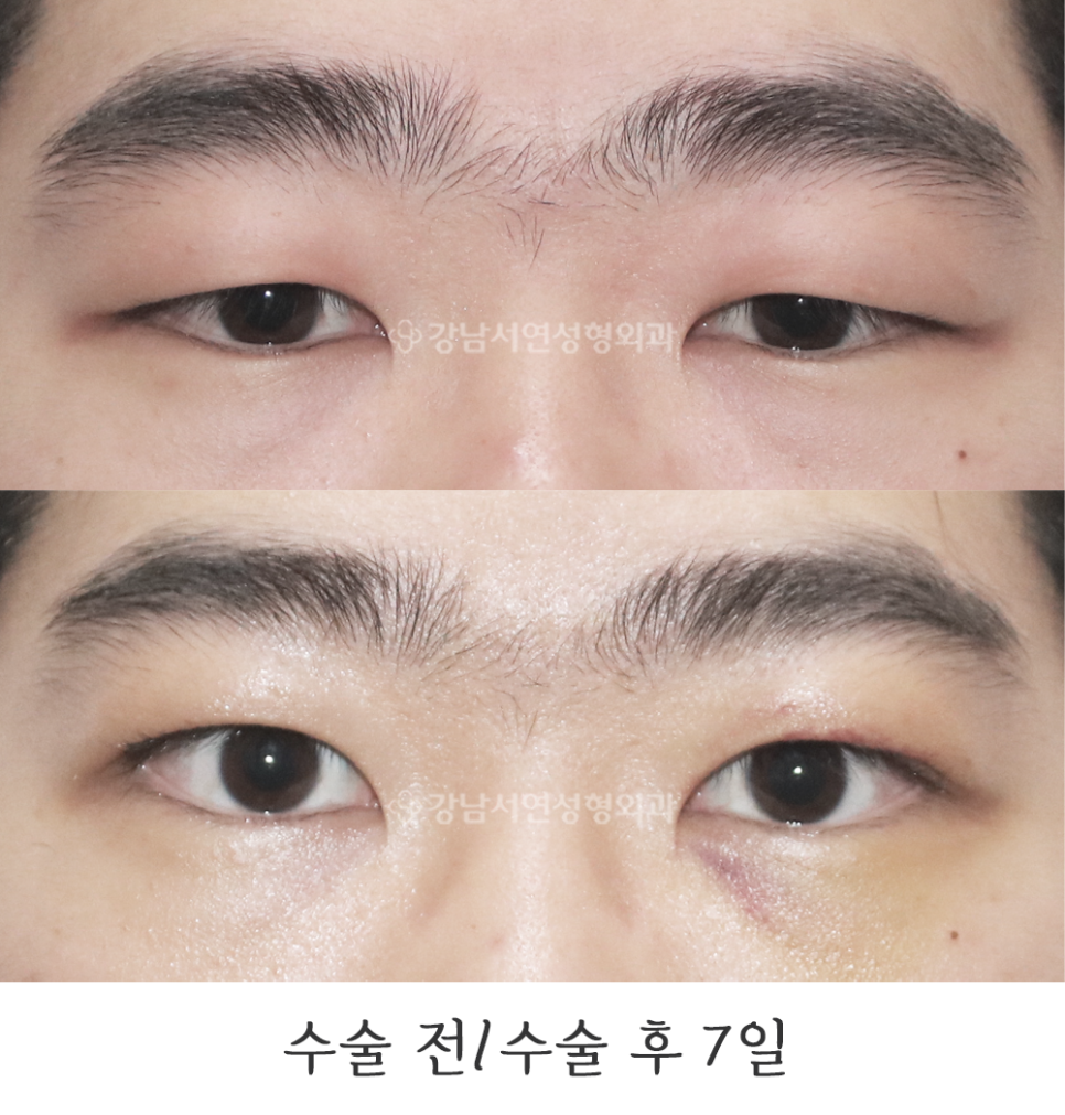 남자 눈성형 수술 전후 비교 사진