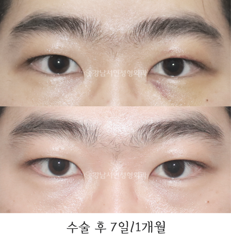 남자 눈성형 수술 전후 비교 사진