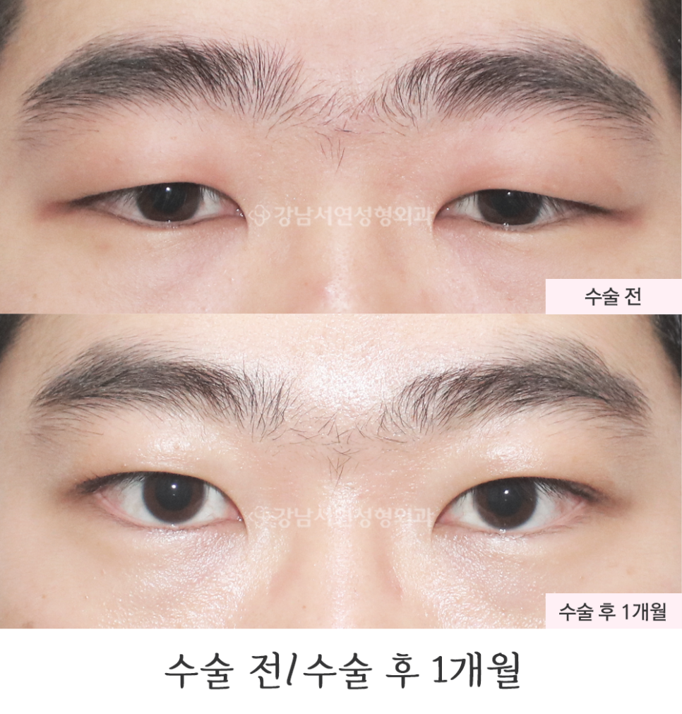 남자 눈성형 수술 전후 비교 사진