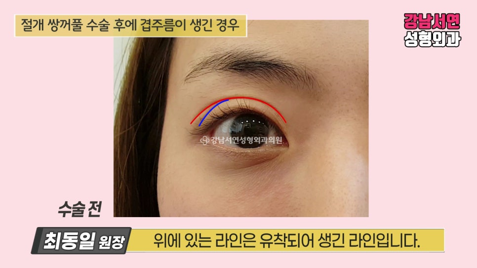 쌍꺼풀 수술 사례 눈 사진
