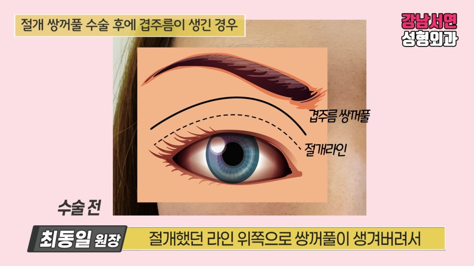 쌍꺼풀 수술 설명 도해