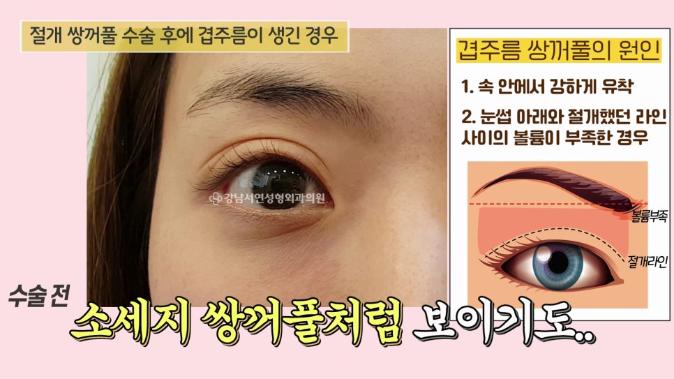 쌍꺼풀 수술 사례 눈 사진