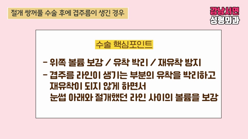 쌍꺼풀 수술 설명 도해