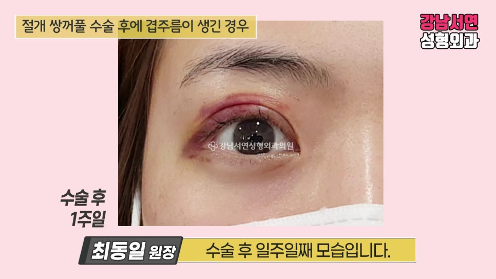쌍꺼풀 수술 후 사진