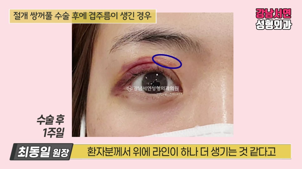 쌍꺼풀 수술 후 사진