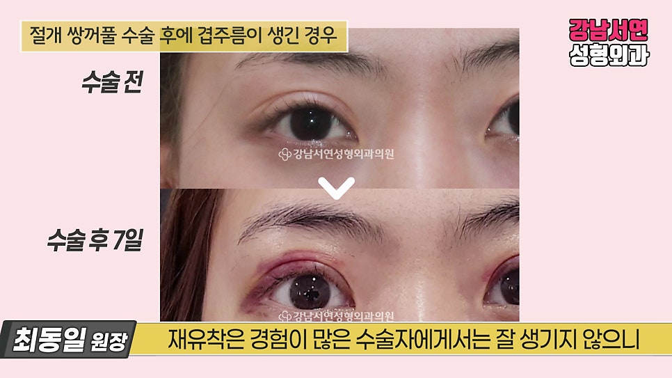 쌍꺼풀 수술 전후 비교 사진