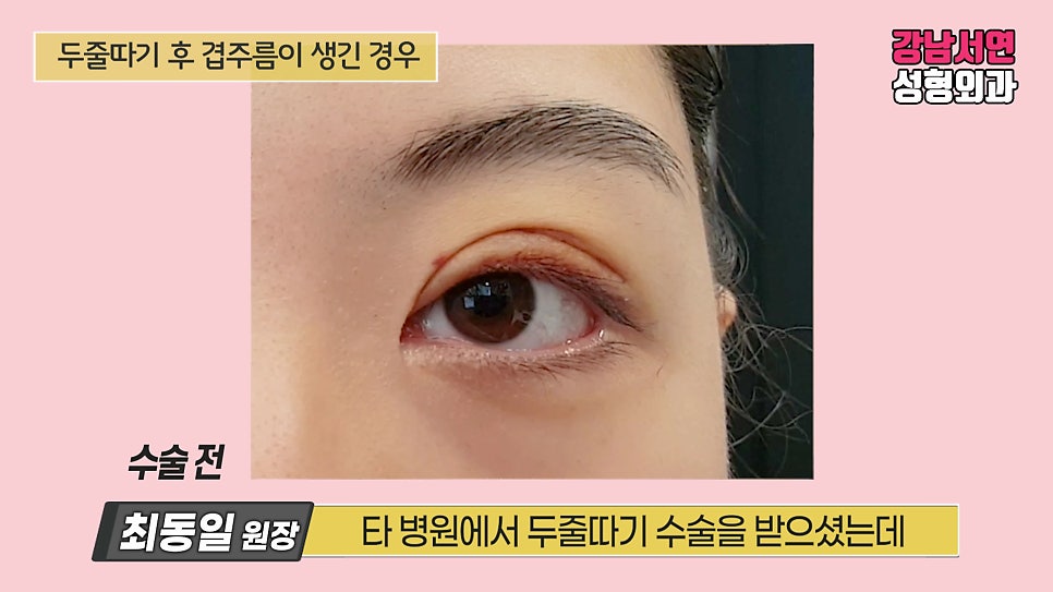 쌍꺼풀 수술 전 사진
