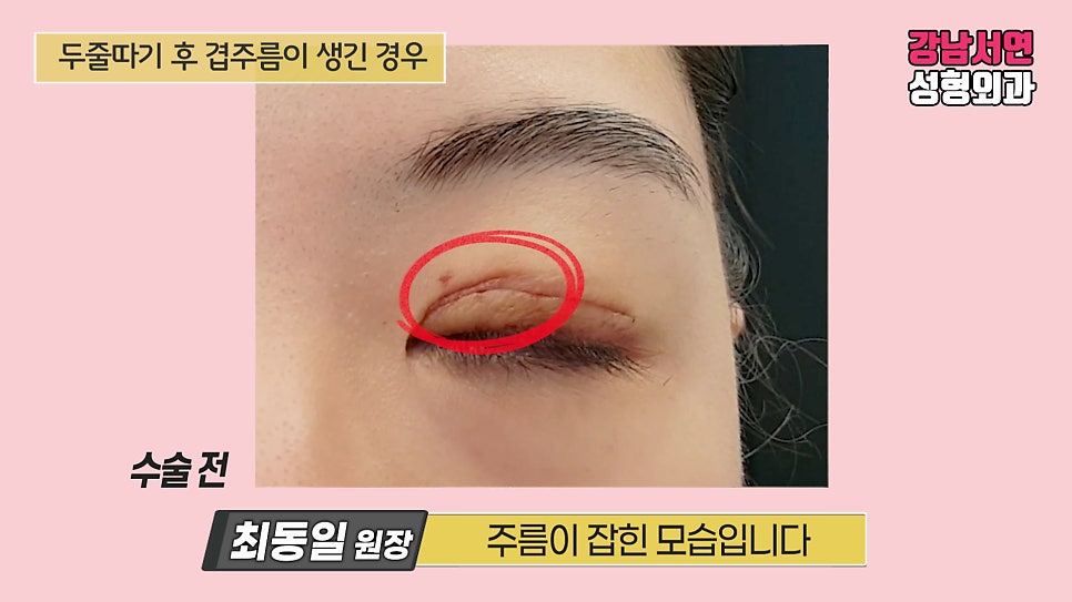 쌍꺼풀 수술 전 사진