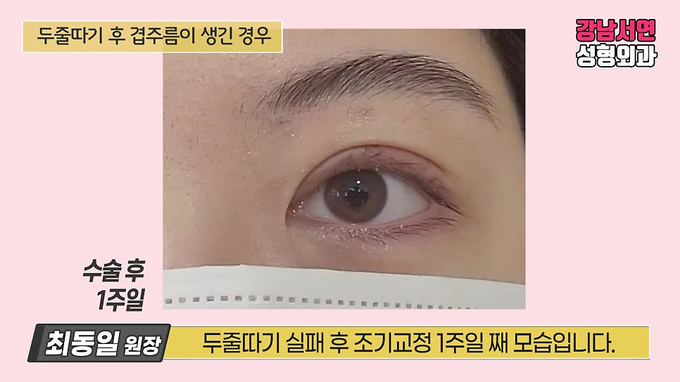 쌍꺼풀 수술 후 사진