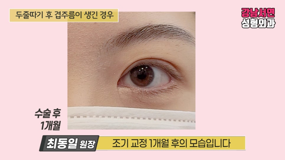 쌍꺼풀 수술 후 사진