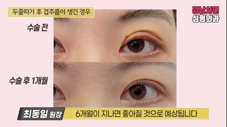 쌍꺼풀 수술 전후 비교 사진