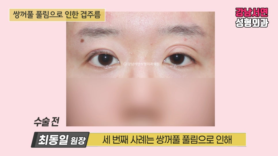 쌍꺼풀 수술 전 사진