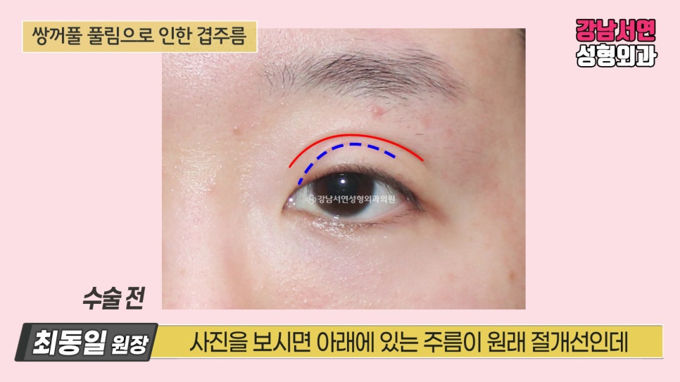 쌍꺼풀 수술 전 사진