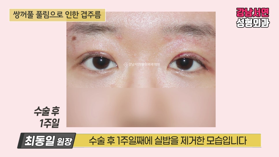 쌍꺼풀 수술 후 사진