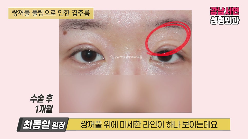쌍꺼풀 수술 후 사진