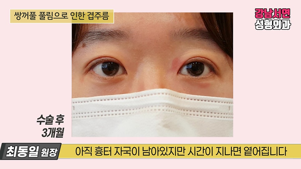 쌍꺼풀 수술 후 사진