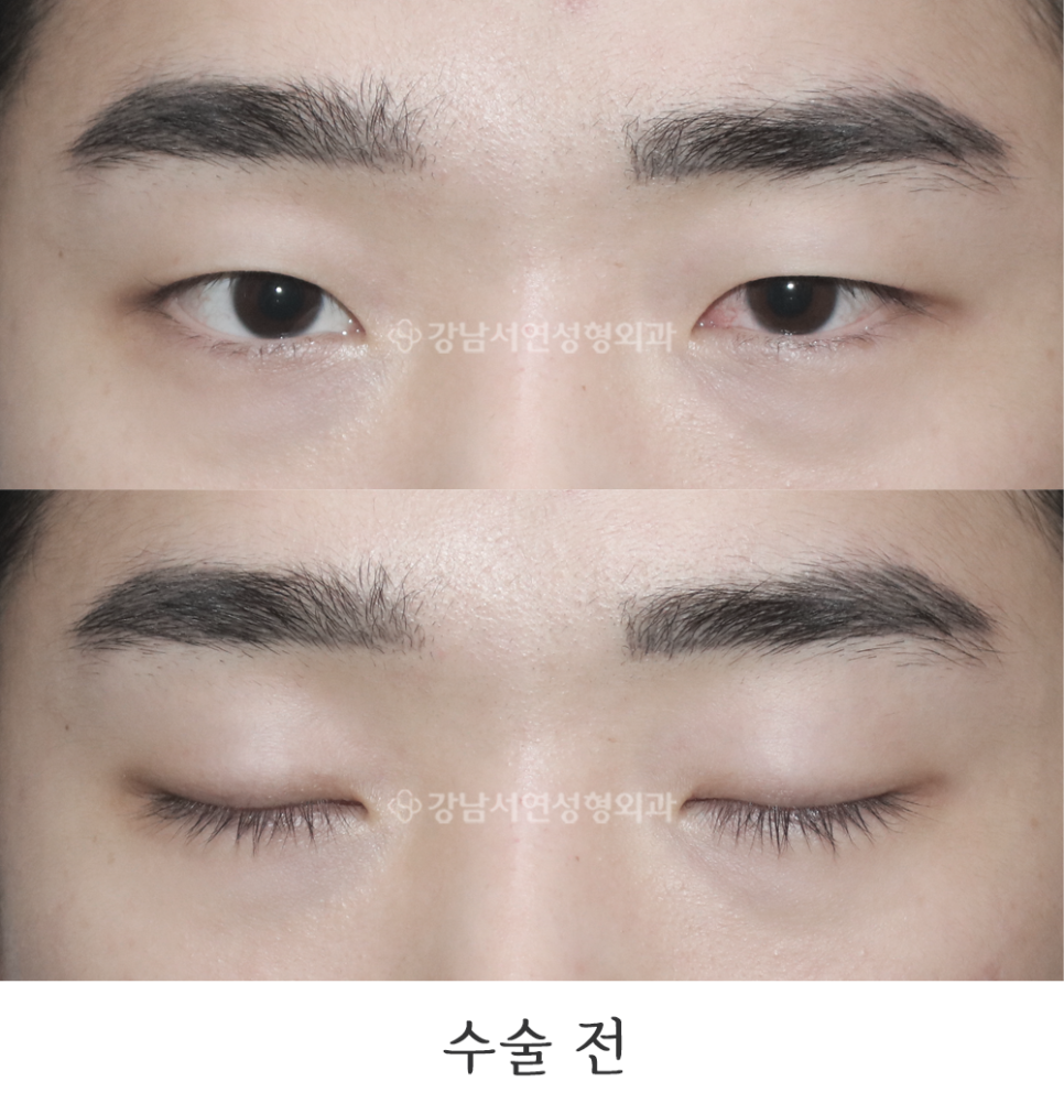 남자 눈성형 수술 전 사진