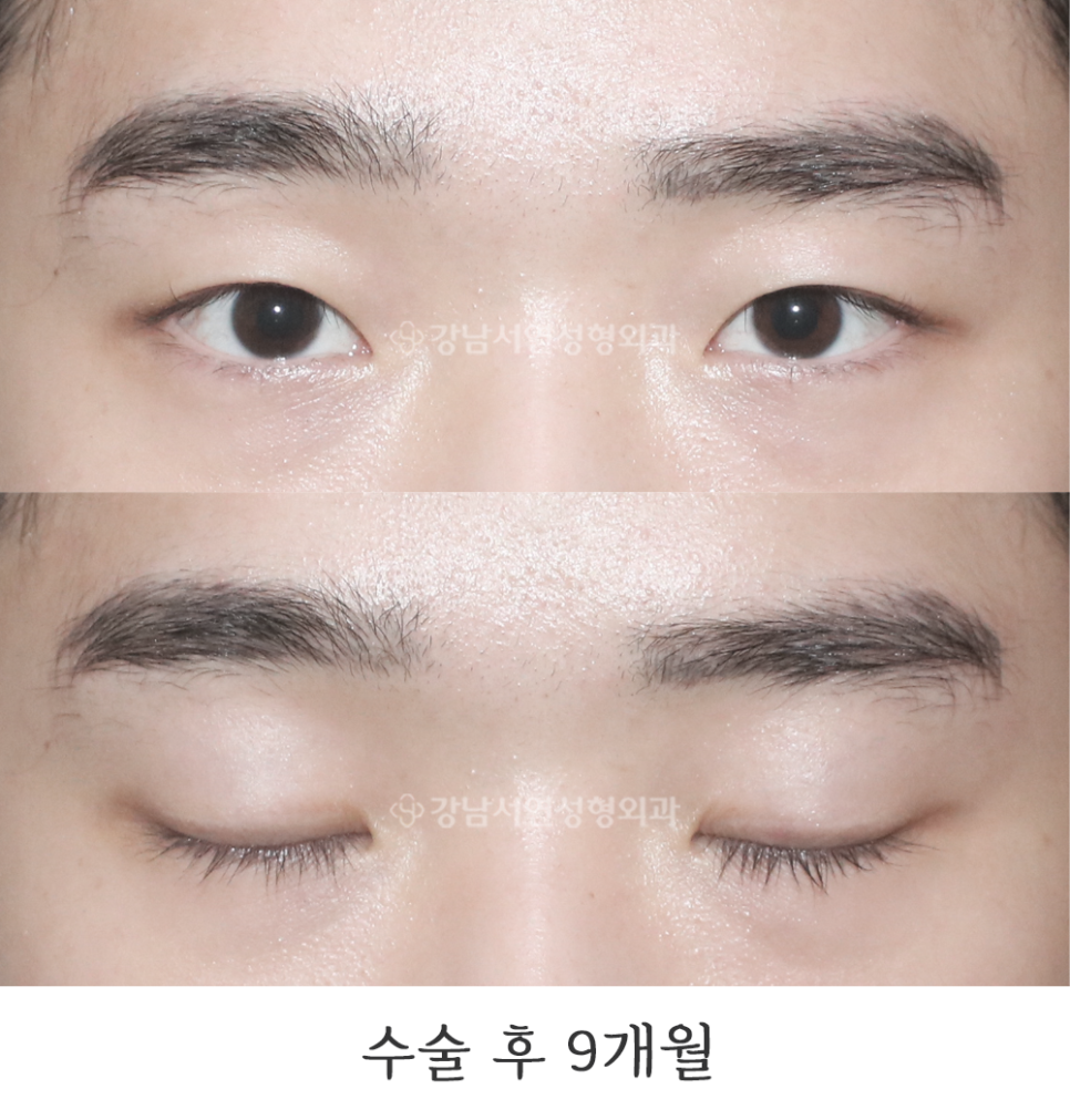 남자 눈성형 수술 후 사진