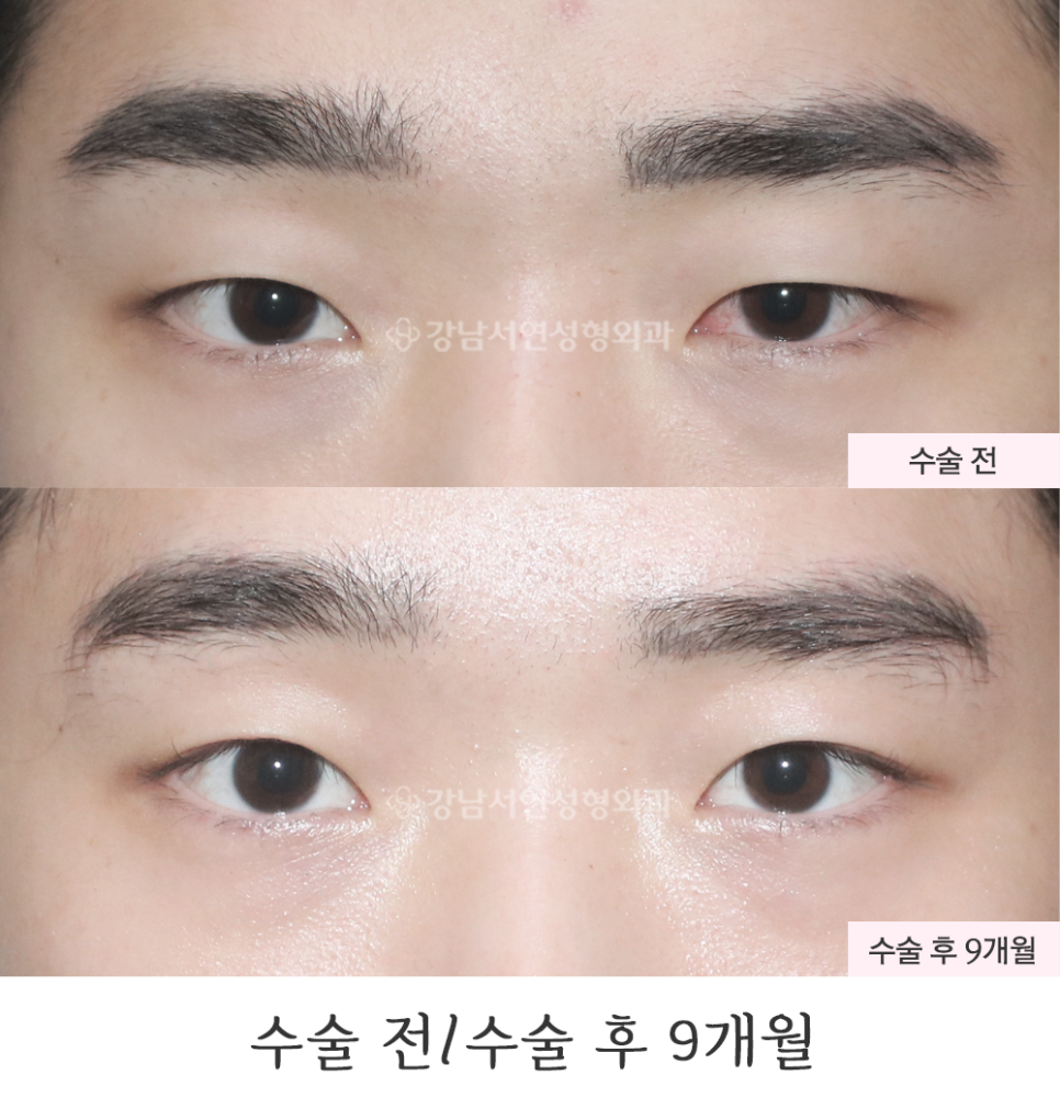 남자 눈성형 수술 전후 비교 사진