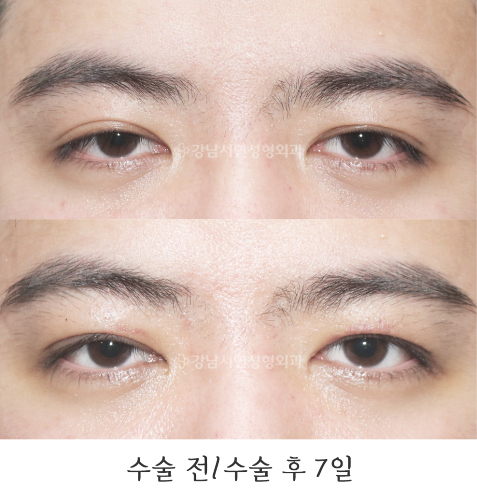 두줄따기 수술 전후 비교 사진