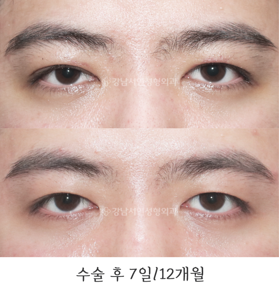 두줄따기 수술 전후 비교 사진