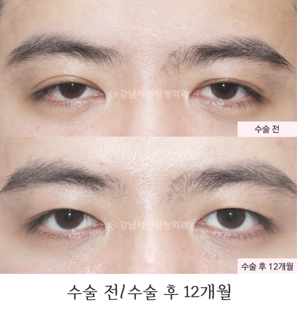 두줄따기 수술 전후 비교 사진