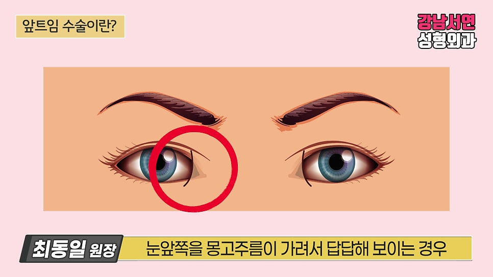 쌍꺼풀 재수술 설명 도해