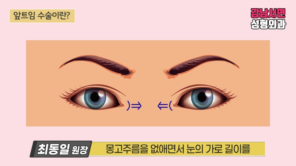 쌍꺼풀 재수술 설명 도해