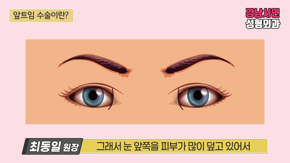 쌍꺼풀 재수술 설명 도해
