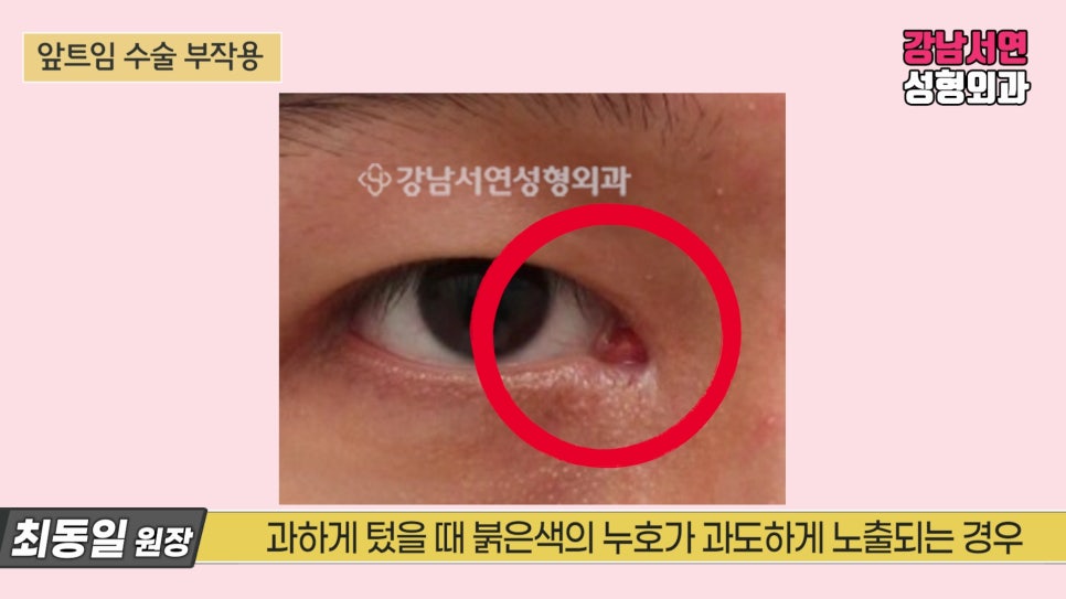 쌍꺼풀 재수술 사례 눈 사진