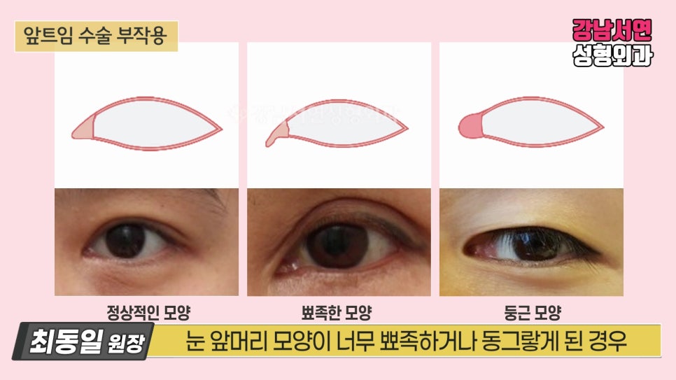 쌍꺼풀 재수술 설명 도해
