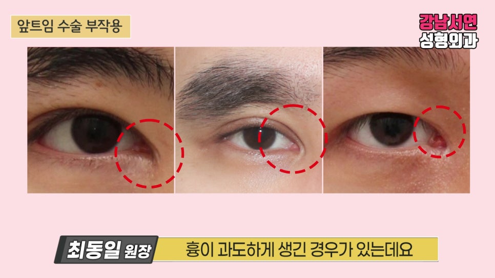 쌍꺼풀 재수술 사례 눈 사진
