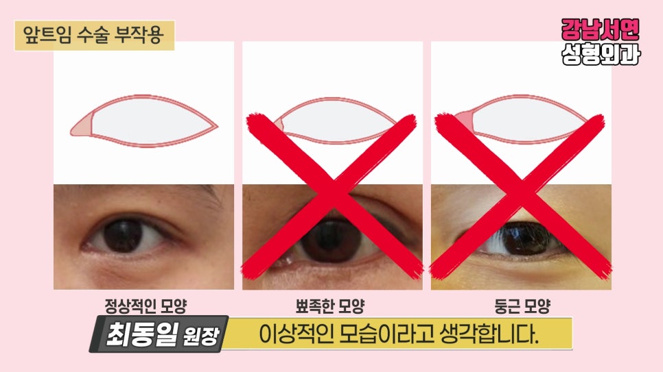 쌍꺼풀 재수술 설명 도해