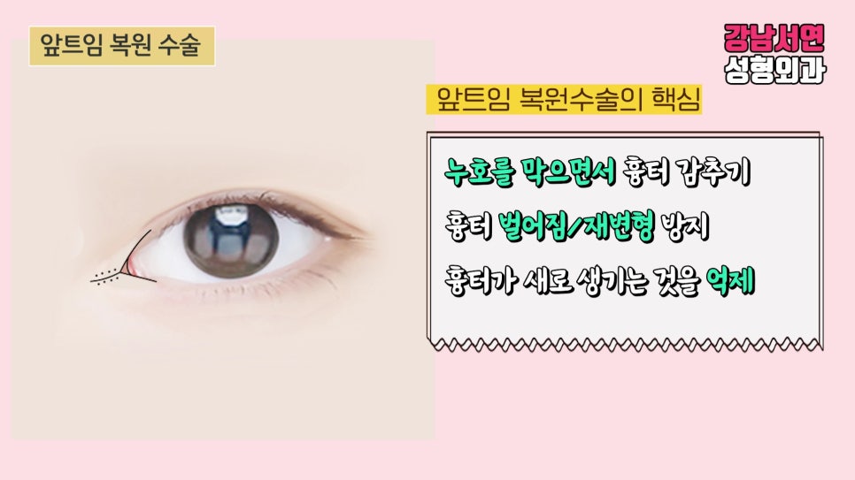 쌍꺼풀 재수술 설명 도해