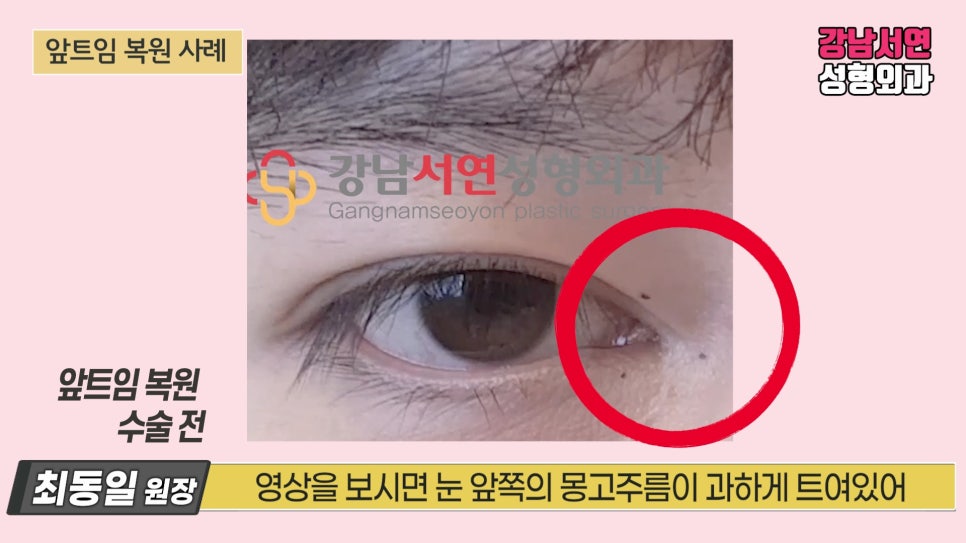 쌍꺼풀 재수술 사례 눈 사진