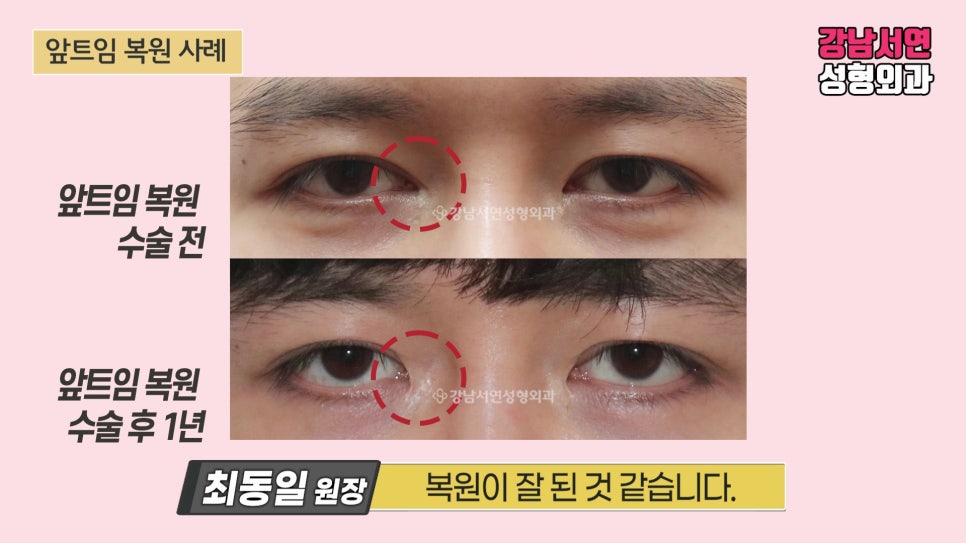 쌍꺼풀 재수술 전후 비교 사진