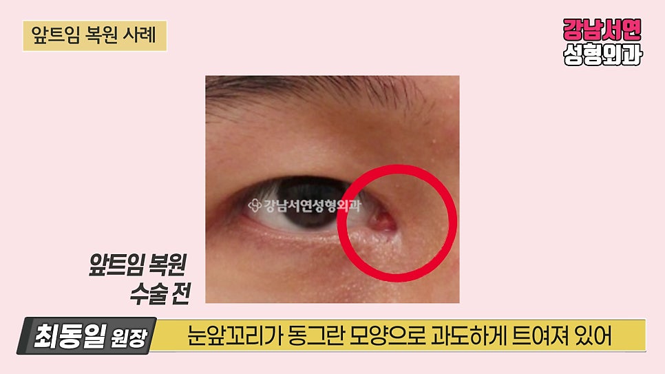 쌍꺼풀 재수술 사례 눈 사진