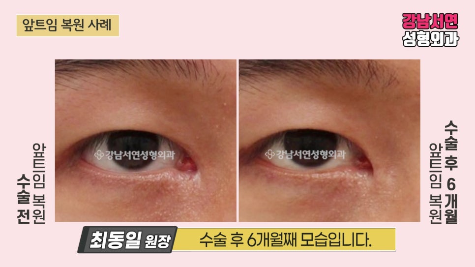 쌍꺼풀 재수술 전후 비교 사진