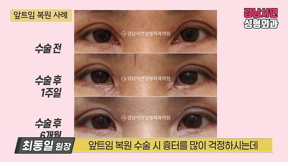 쌍꺼풀 재수술 전후 비교 사진