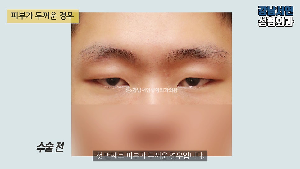 남자 눈성형 수술 전 사진