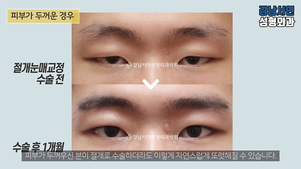 남자 눈성형 수술 전후 비교 사진