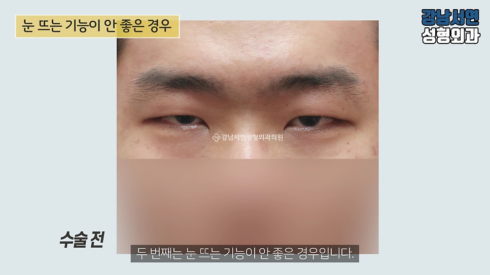 남자 눈성형 수술 전 사진