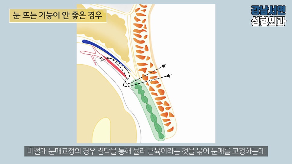남자 눈성형 설명 도해