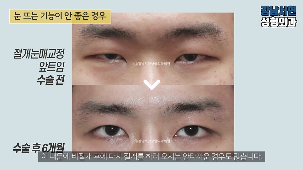 남자 눈성형 수술 전후 비교 사진